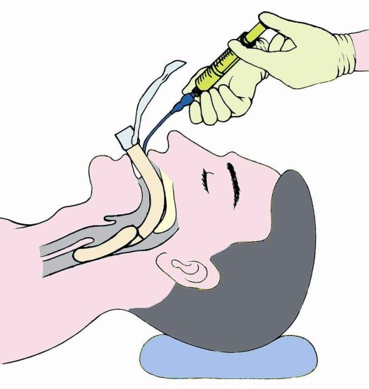 High Quality Disposable Medical Laryngeal Mask Airway