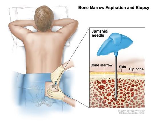 Single-Use Bone Marrow Aspiration Needle with High Quality